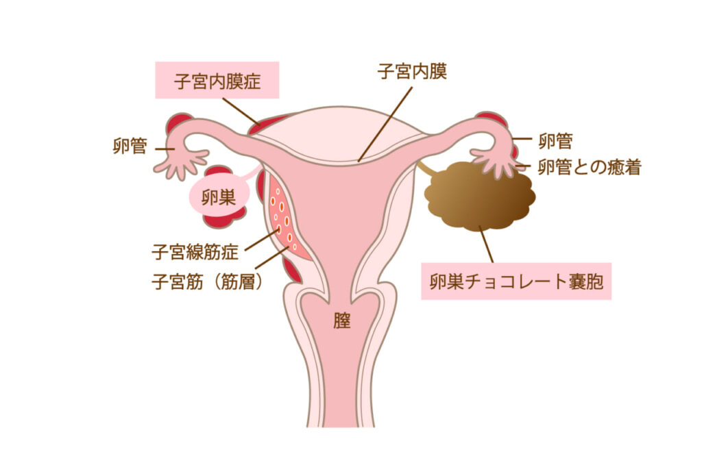 チョコレート嚢胞