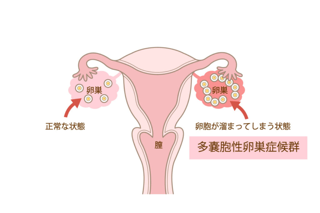 多嚢胞性卵巣